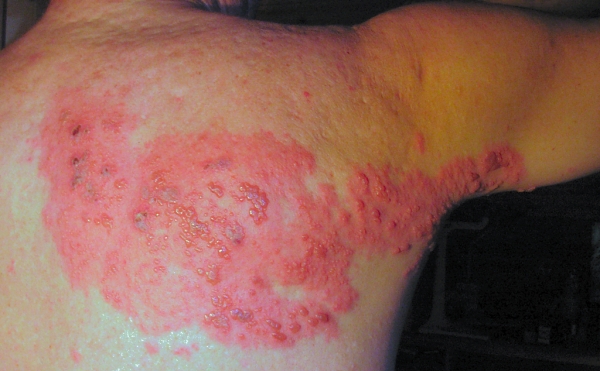 대상포진의 피부 병변 증상. (사진=Wikimedia Commons)