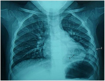 왼쪽 아래 폐렴과 흉수 증상을 보이는 어린이의 흉부 X선 촬영 사진. (사진=Wikimedia commons)