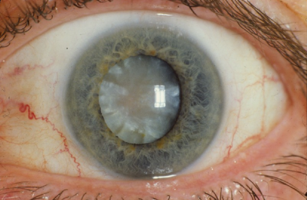 백내장은 눈 안의 수정체에 뿌옇게 혼탁이 생기는 질환을 말한다. 99%는 통증이 동반되지 않는다. (사진=Wikimedia Commons)