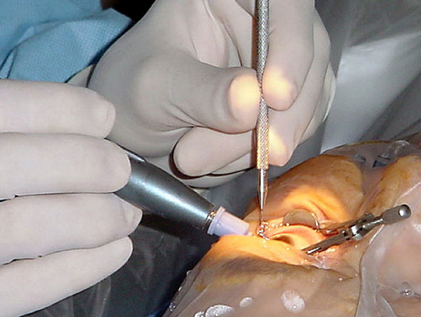 백내장 수술은 2.2mm~2.8mm 절개창을 내고 수술하기 때문에 수술 후 세균감염 등에 주의해야 한다. (사진=Wikimedia Commons)