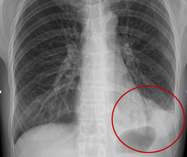 폐렴 환자의 X-RAY 영상. (사진=분당제생병원 제공)